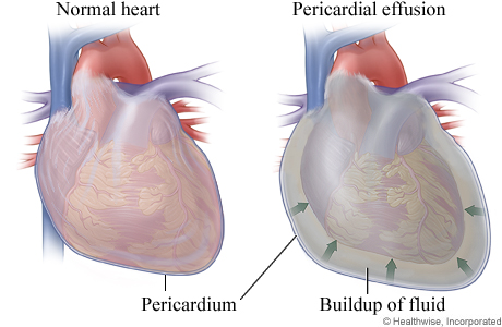 HVIPericardialEffusion.jpg